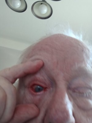 Eye Redness.jpg